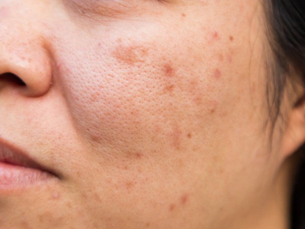 problems-facial-skin-is-acne-blemishes_1388-2117